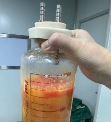 栖霞水动力吸脂手术要做多久？